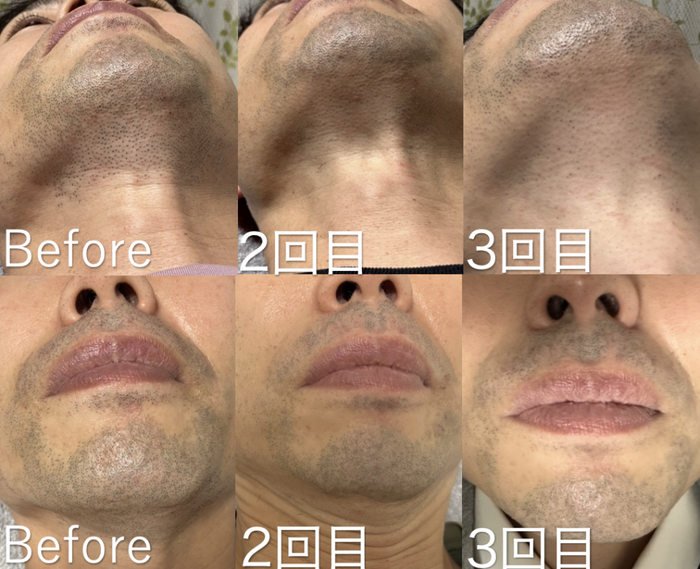 ひげを完全に生やすにはどのくらい時間がかかりますか?